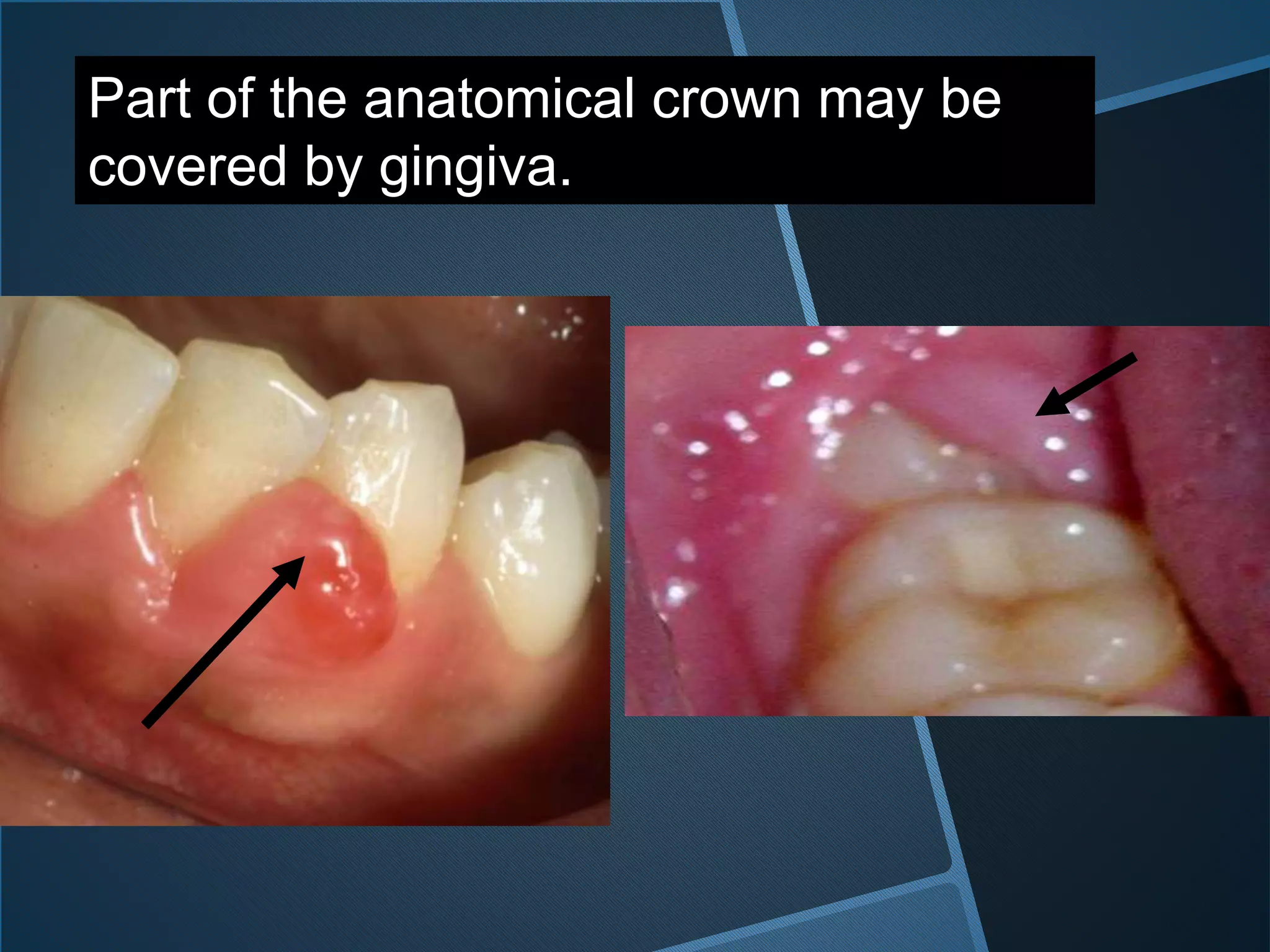 Part of the anatomical crown may be
covered by gingiva.
 