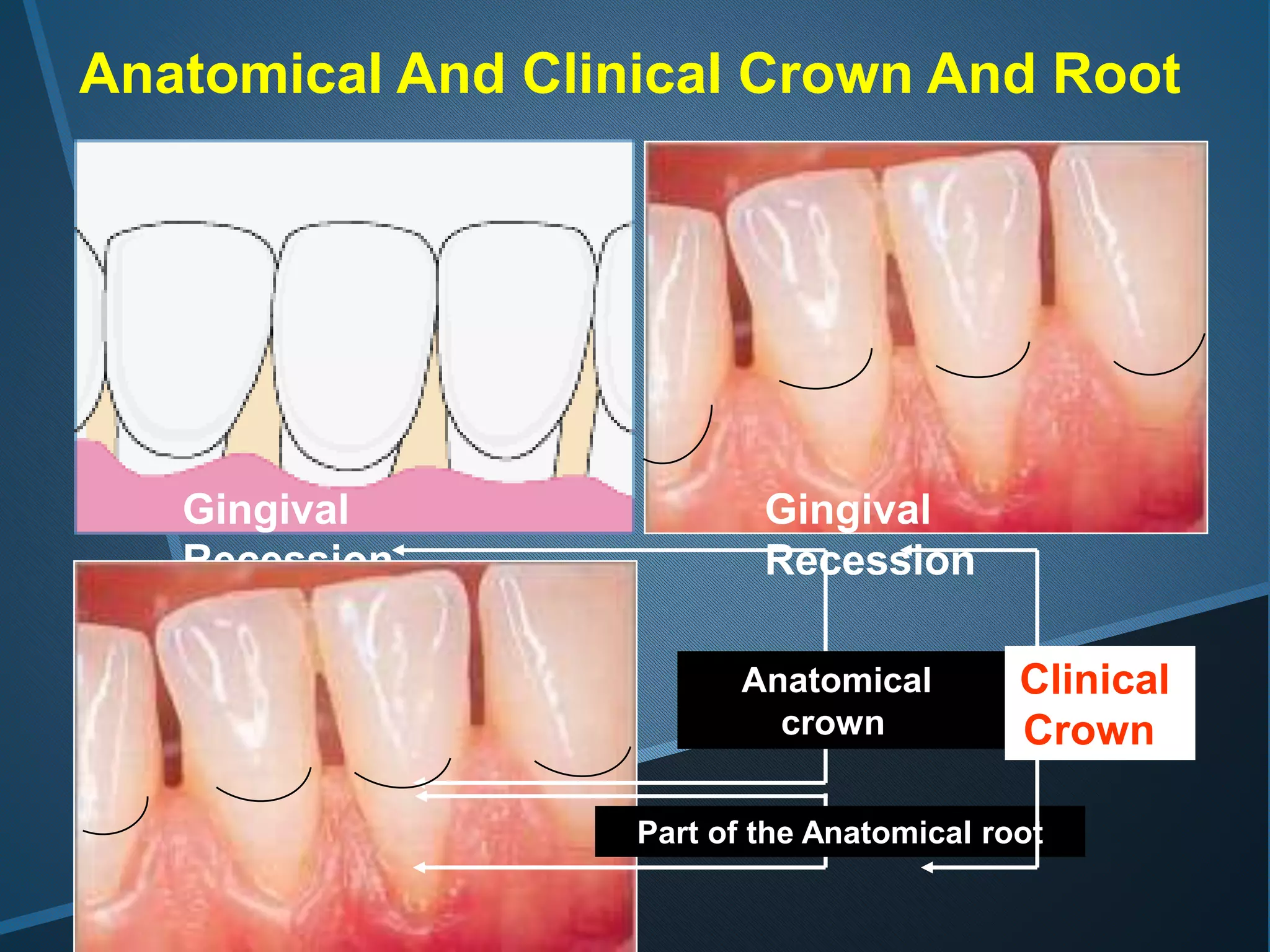 Anatomical And Clinical Crown And Root
Gingival
Recession
Gingival
Recession
Anatomical
crown
Part of the Anatomical root
Clinical
Crown
 