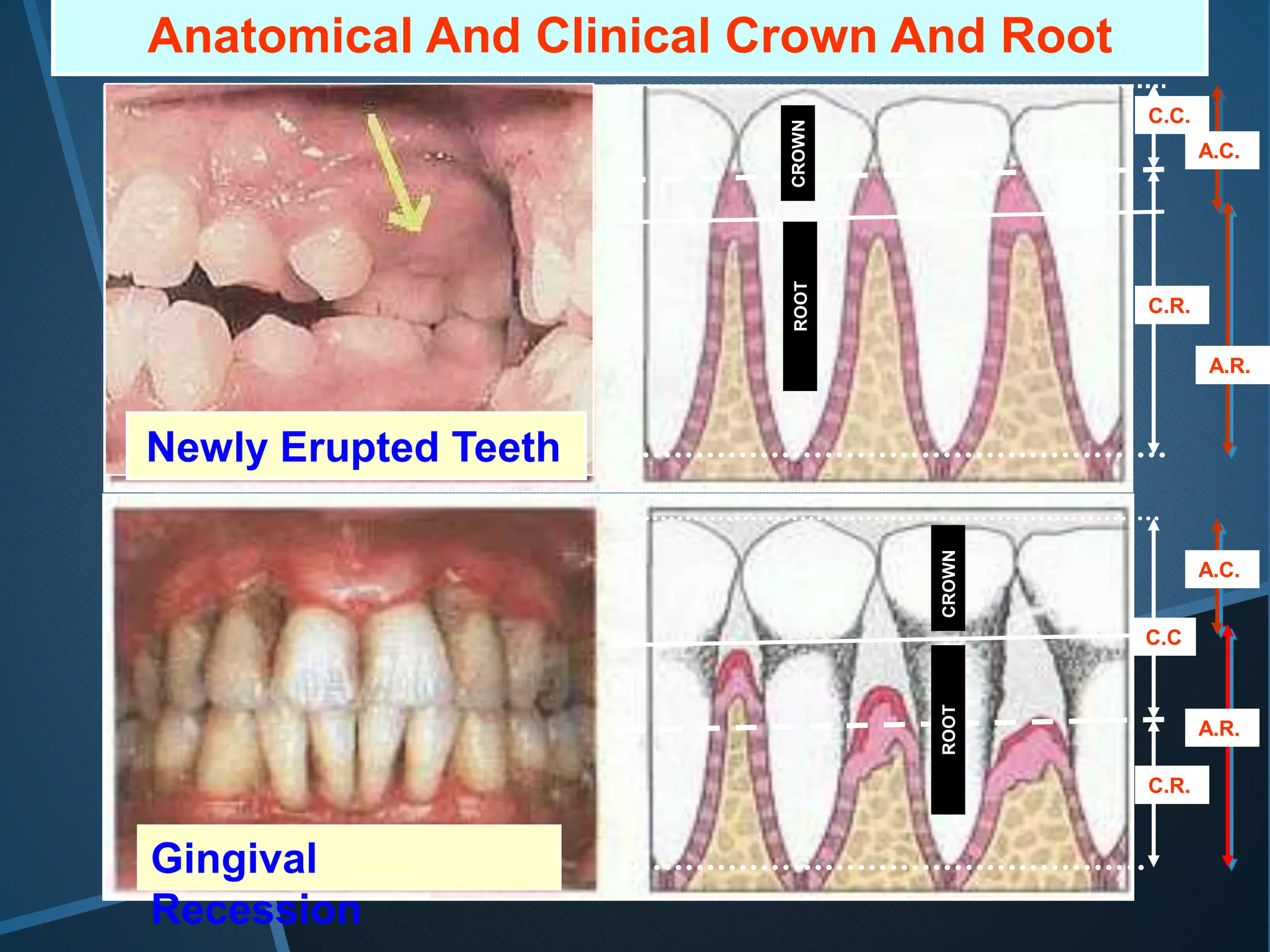 C.C.
A.C.
C.R.
A.R.
C.C
C.R.
A.C.
A.R.
CROWN
CROWN
ROOT
ROOT
Gingival
Recession
Newly Erupted Teeth
Anatomical And Clinical Crown And Root
 