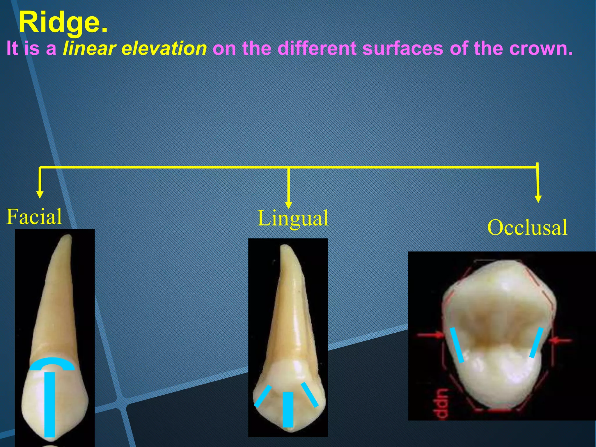 Ridge.
It is a linear elevation on the different surfaces of the crown.
Facial Lingual Occlusal
 