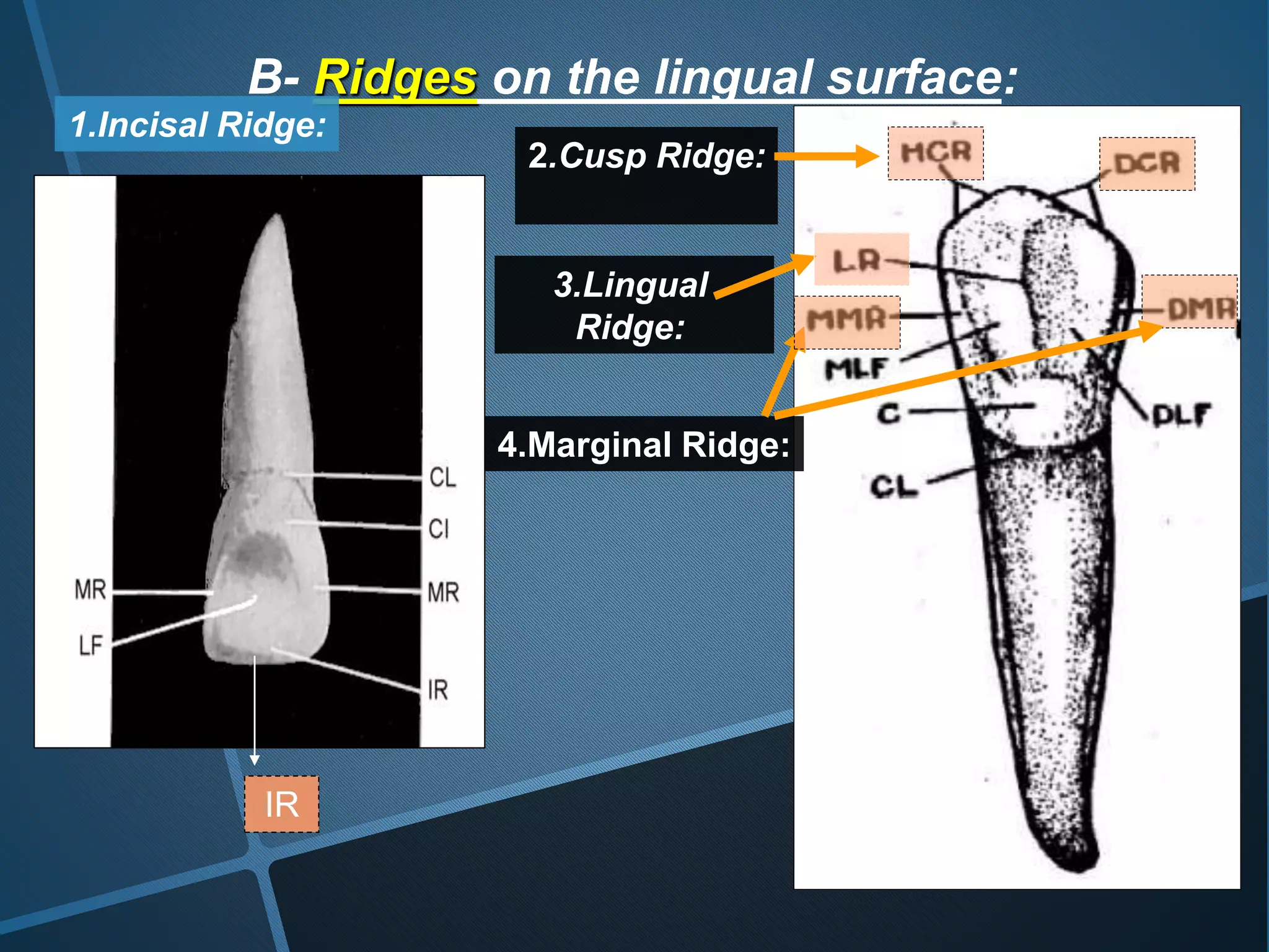 B- Ridges on the lingual surface:
1.Incisal Ridge:
3.Lingual
Ridge:
4.Marginal Ridge:
2.Cusp Ridge:
IR
 