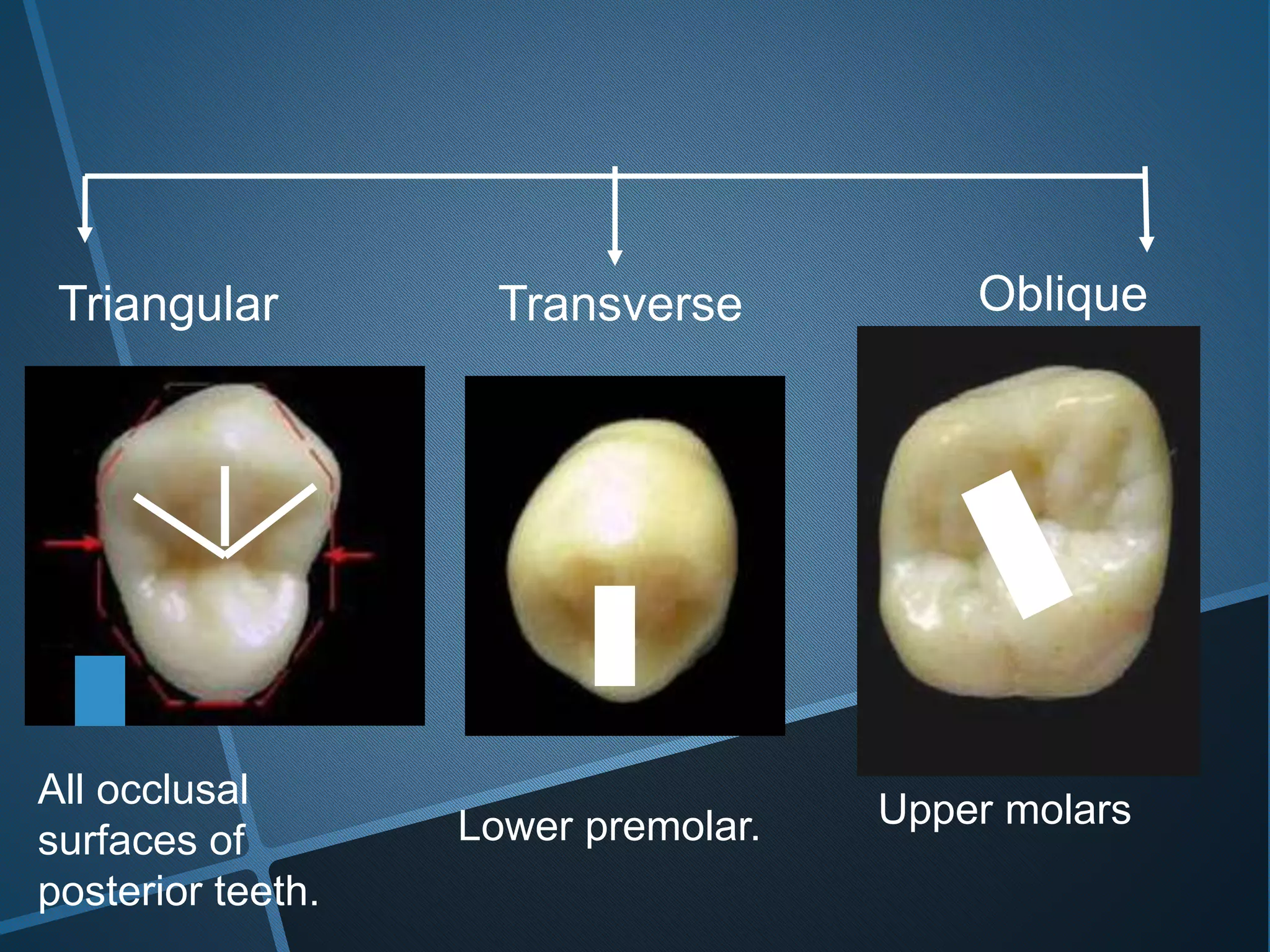 Triangular ObliqueTransverse
All occlusal
surfaces of
posterior teeth.
Lower premolar. Upper molars
 
