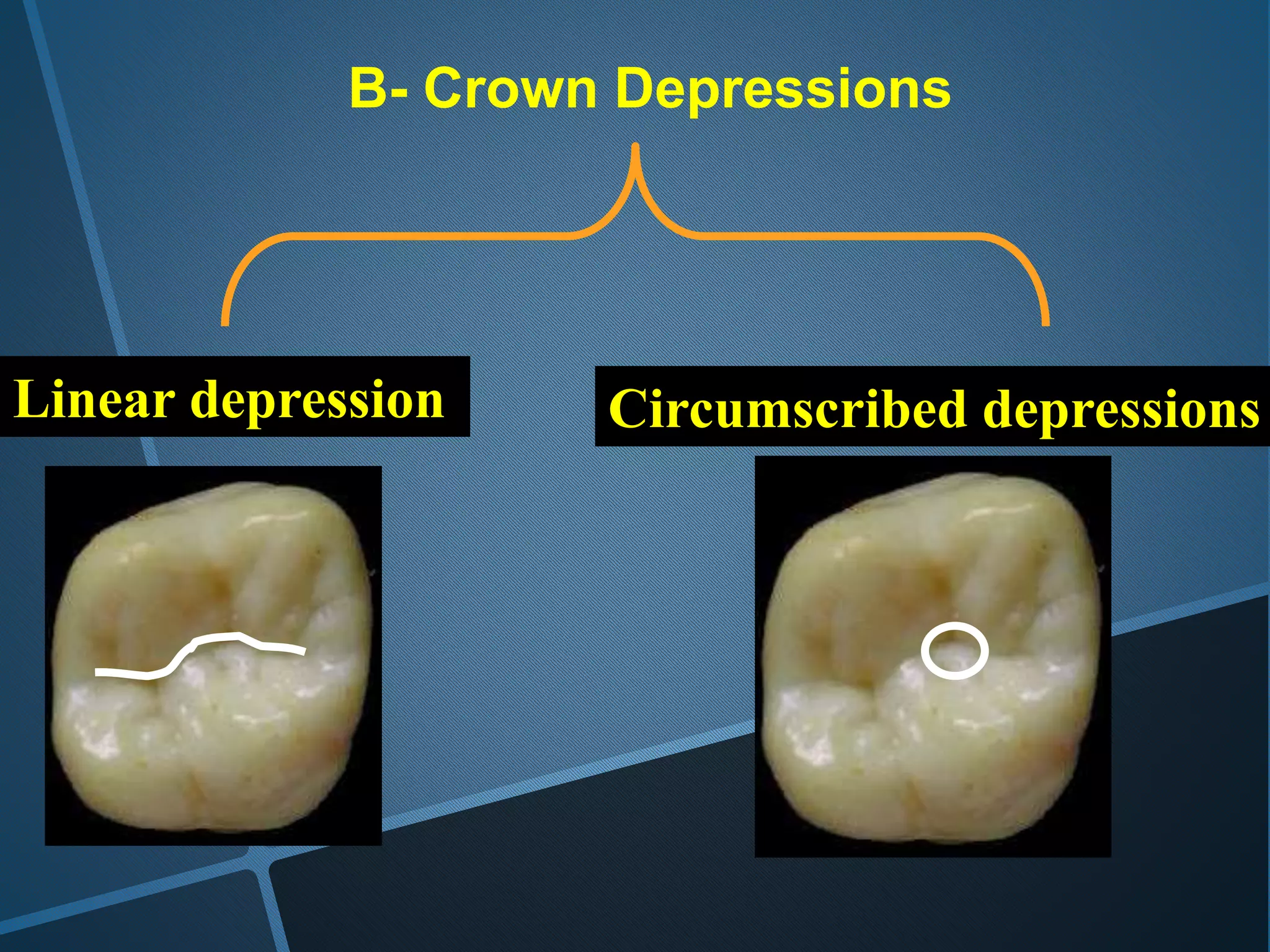 B- Crown Depressions
Linear depression Circumscribed depressions
 