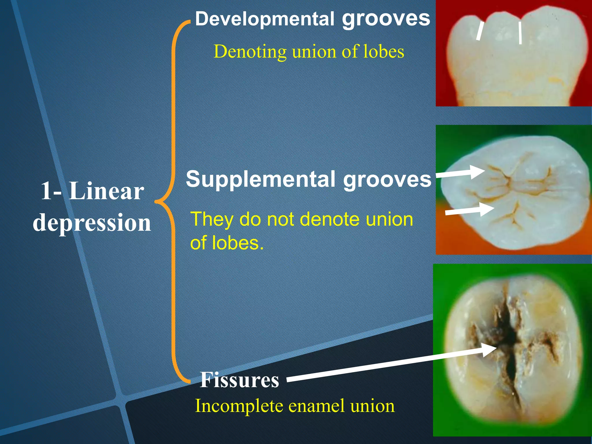1- Linear
depression
Developmental grooves
Supplemental grooves
Fissures
Denoting union of lobes
They do not denote union
of lobes.
Incomplete enamel union
 