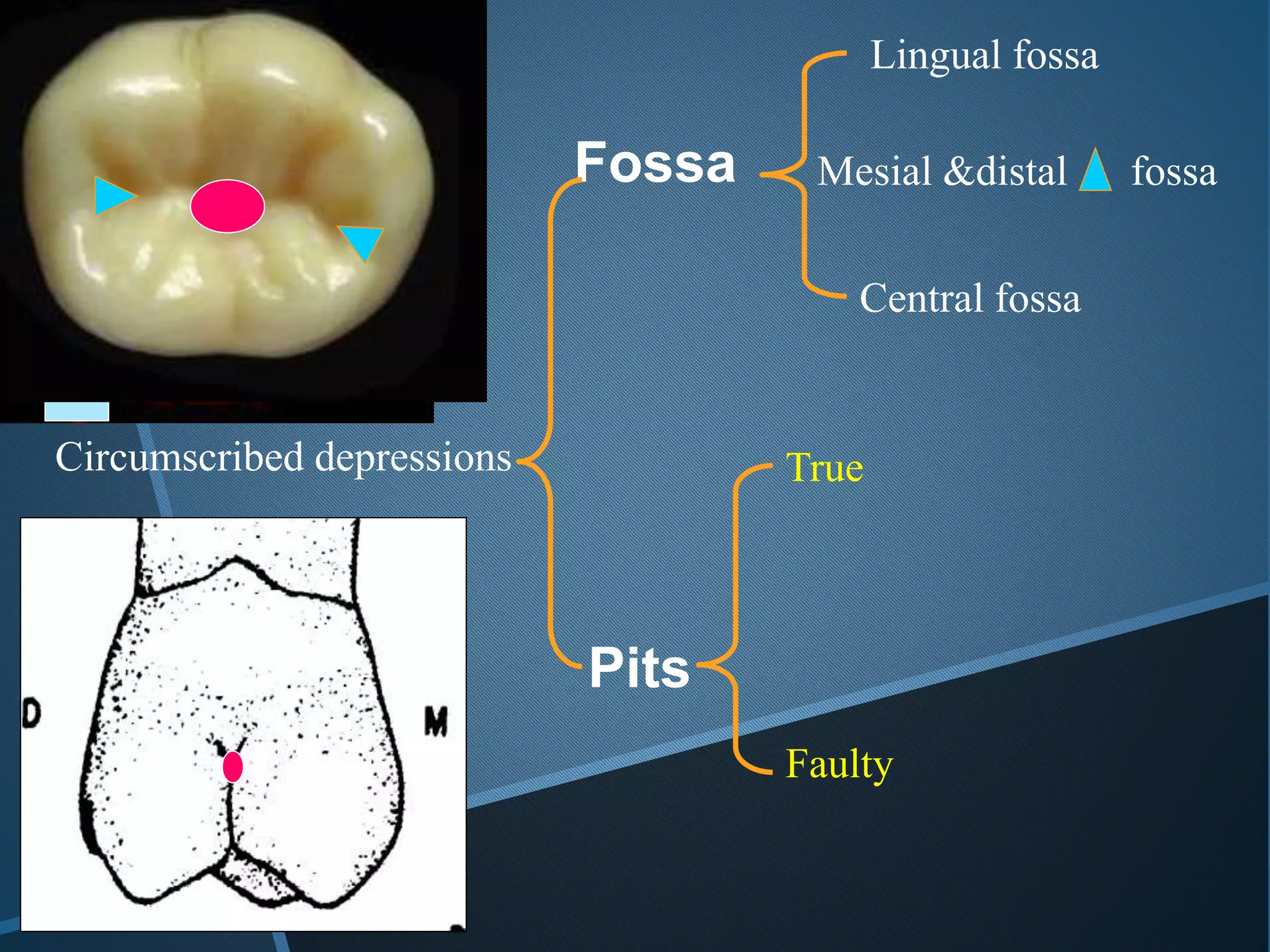 Fossa
Circumscribed depressions
Pits
Lingual fossa
Mesial &distal fossa
Central fossa
True
Faulty
 