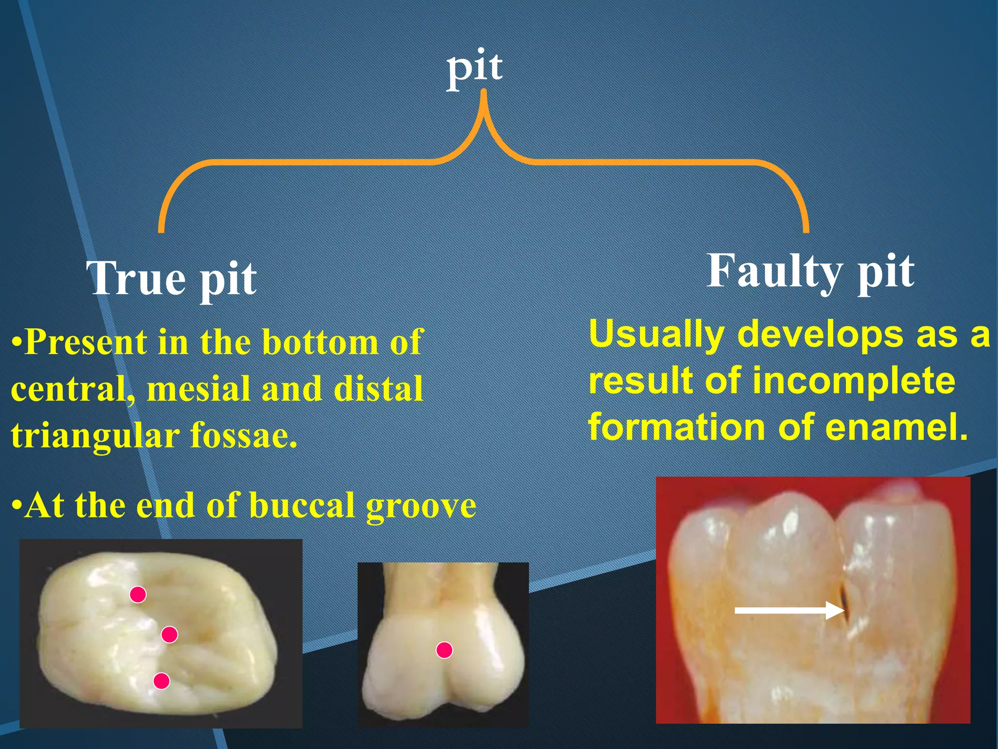 True pit Faulty pit
•Present in the bottom of
central, mesial and distal
triangular fossae.
•At the end of buccal groove
Usually develops as a
result of incomplete
formation of enamel.
pit
 