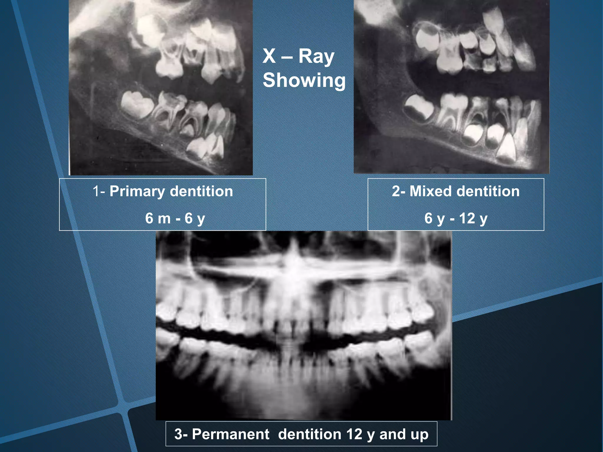 1- Primary dentition
6 m - 6 y
3- Permanent dentition 12 y and up
2- Mixed dentition
6 y - 12 y
X – Ray
Showing
 