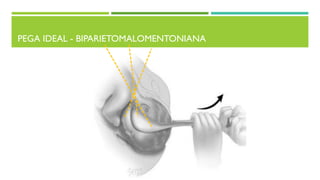 PEGA IDEAL - BIPARIETOMALOMENTONIANA
 