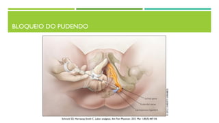 BLOQUEIO DO PUDENDO
Schrock SD, Harraway-Smith C. Labor analgesia. Am Fam Physician. 2012 Mar 1;85(5):447-54.
 