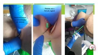 M
Medida até a
fúrcula vaginal
Posicionamento
e centralização
da ventosa
 