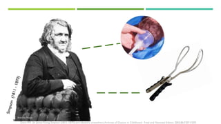 Dunn PM Sir JamesYoung Simpson (1811–1870) and obstetric anaesthesia Archives of Disease in Childhood - Fetal and Neonatal Edition 2002;86:F207-F209.
Antonia Reeve
 
