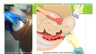 St George’s Hospital – NHS London Liberação do Maxilar e Raiz da Mandíbula
 