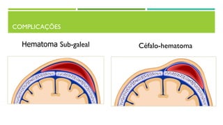 Hematoma Sub-galeal Céfalo-hematoma
COMPLICAÇÕES
 