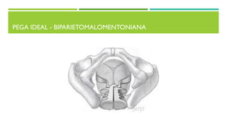 PEGA IDEAL - BIPARIETOMALOMENTONIANA
 