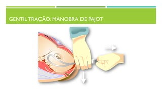 GENTIL TRAÇÃO: MANOBRA DE PAJOT
 