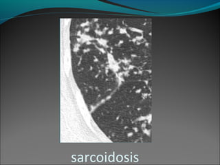 sarcoidosis
 