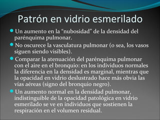 Patrón en vidrio esmerilado
Un aumento en la “nubosidad” de la densidad del
parénquima pulmonar.
No oscurece la vasculatura pulmonar (o sea, los vasos
siguen siendo visibles).
Comparar la atenuación del parénquima pulmonar
con el aire en el bronquio: en los individuos normales
la diferencia en la densidad es marginal, mientras que
la opacidad en vidrio deslustrado hace más obvia las
vías aéreas (signo del bronquio negro).
Un aumento normal en la densidad pulmonar,
indistinguible de la opacidad patológica en vidrio
esmerilado se ve en individuos que sostienen la
respiración en el volumen residual.
 