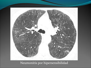 Neumonitis por hipersensibilidad
 