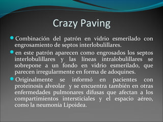 Crazy Paving
Combinación del patrón en vidrio esmerilado con
engrosamiento de septos interlobulillares.
en este patrón aparecen como engrosados los septos
interlobulillares y las líneas intralobulillares se
sobrepone a un fondo en vidrio esmerilado, que
parecen irregularmente en forma de adoquines.
Originalmente se informó en pacientes con
proteinosis alveolar y se encuentra también en otras
enfermedades pulmonares difusas que afectan a los
compartimientos intersticiales y el espacio aéreo,
como la neumonía Lipoidea.
 