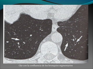 Ojo con la confluencia de los bronquios segmentarios
 