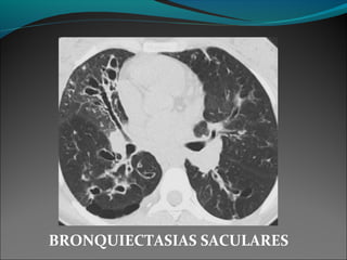 BRONQUIECTASIAS SACULARES
 