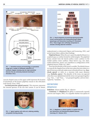 crescent-shaped crease on the upper eyelid represents the location
of attachment of the levator palpebrae muscle to the or...