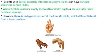 * Patients with partial posterior interosseous nerve lesions can have variable
weakness in each finger.
* When weakness occurs in only the fourth and fifth digits, a pseudo–ulnar claw
hand can develop.
* However, there is no hyperextension at the knuckle joints, which differentiates it
from a true claw hand.
 