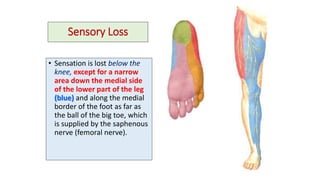 Sensory Loss
• Sensation is lost below the
knee, except for a narrow
area down the medial side
of the lower part of the leg
(blue) and along the medial
border of the foot as far as
the ball of the big toe, which
is supplied by the saphenous
nerve (femoral nerve).
 