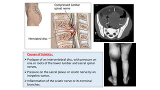 Causes of Sciatica :
Prolapse of an intervertebral disc, with pressure on
one or roots of the lower lumbar and sacral spinal
nerves,
Pressure on the sacral plexus or sciatic nerve by an
intrpelvic tumor,
Inflammation of the sciatic nerve or its terminal
branches.
 