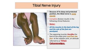 Tibial Nerve Injury
• Because of its deep and protected
position, the tibial nerve is rarely
injured.
• Complete division results in the
following clinical features:
• Motor:
• All the muscles in the back of the leg
and the sole of the foot are
paralyzed.
• The opposing muscles Dorsiflex the
foot at the ankle joint and Evert the
foot at the subtalar joint, an attitude
referred to as Taleps
Calcaneovalgus.
 
