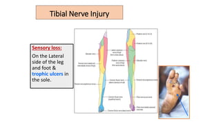 Tibial Nerve Injury
Sensory loss:
On the Lateral
side of the leg
and foot &
trophic ulcers in
the sole.
 
