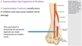 2- Supracondylar Spur/Ligament of Struthers
3- Supracondylar Fractures usually occur
in children and may cause median nerve
damage.
This canal which is
formed by this accessory
ligament can make
compression on median
nerve
 