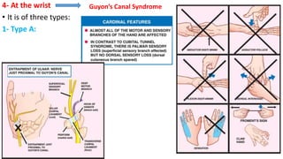 4- At the wrist
• It is of three types:
1- Type A:
Guyon’s Canal Syndrome
 