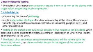 Ultrasonographic Testing
* The normal ulnar nerve cross sectional area is 8 mm to 11 mm at the elbow, with
larger values suggesting focal compression.
* It is helpful in:
- pinpointing the area of pathology
- identify alternative etiologies for ulnar neuropathy at the elbow like anatomic
variants (eg, anomalous anconeus epitrochlearis muscle), ganglion cysts, and
other mass lesions
* Testing of the dorsal ulnar cutaneous sensory nerve response can be added when
assessing lesions distal to the elbow, assisting in localization of ulnar nerve lesions
at or proximal to the wrist.
* The dorsal ulnar cutaneous sensory nerve response will be normal with the
lesions at the wrist, but abnormal with lesions in the region of the proximal
forearm or elbow.
 