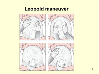 Leopold maneuver




                   8
 