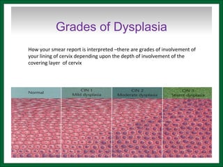 Grades of Dysplasia
How your smear report is interpreted –there are grades of involvement of
your lining of cervix depending upon the depth of involvement of the
covering layer of cervix
 