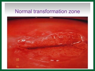 Normal transformation zone
 