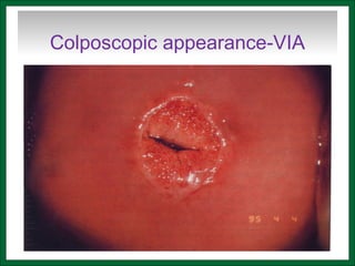 Colposcopic appearance-VIA
 