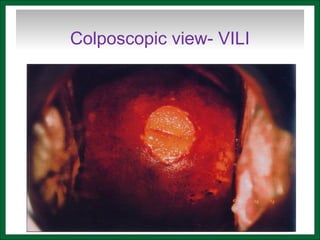 Colposcopic view- VILI
 