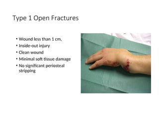 Simple Open Injuries 2- Principles_of_fractures for physiotherapy .ppt