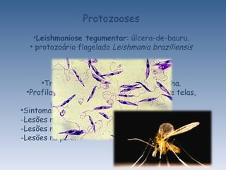 Protozooses Leishmaniose tegumentar : úlcera-de-bauru. protozoário flagelado  Leishmania braziliensis Transmissão: picada do mosquito-palha. Profilaxia: combate aos mosquitos, uso de telas, mosquiteiros. Sintomas:  -Lesões no nariz; Lesões na boca; Lesões na pele. 