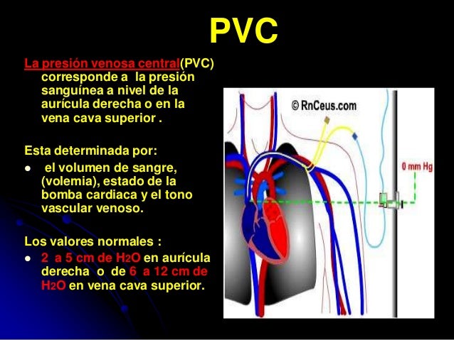 Resultado de imagen para presion venosa central