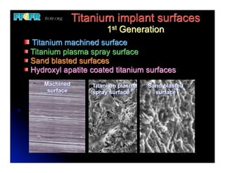Titanium implant surfaces
                      1st Generation
Titanium machined surface
Titanium plasma spray surface
Sand blasted surfaces
Hydroxyl apatite coated titanium surfaces
   Machined       Titanium plasma   Sand blasted
    surface       spray surface       surface
 