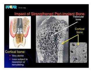 Impact of Strengthened Peri-implant Bone
                                          Trabecular
                                             bone



                                           Cortical
                                            bone




Cortical bone:
  l   Very dense
  l   Less subject to
       resorption or
       remodeling
 