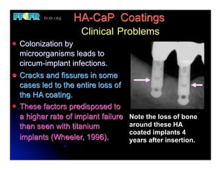 HA-CaP Coatings
                        Clinical Problems
l   Colonization by
     microorganisms leads to
     circum-implant infections.
l   Cracks and fissures in some
     cases led to the entire loss of
     the HA coating.
l   These factors predisposed to
     a higher rate of implant failure   Note the loss of bone
     than seen with titanium            around these HA
                                        coated implants 4
     implants (Wheeler, 1996).          years after insertion.
 