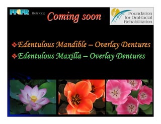 Coming soon

vEdentulous Mandible – Overlay Dentures
vEdentulous Maxilla – Overlay Dentures
 
