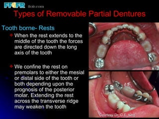 Mesial Rest Rpd 2.rpd biomechanics | PPT