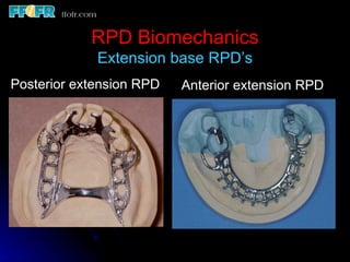 Beading Rpd 2.rpd biomechanics | PPT