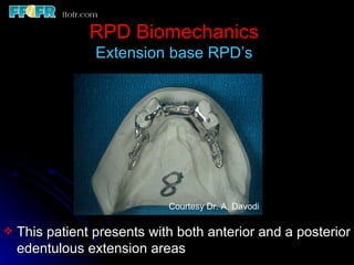 2.rpd biomechanics | PPT