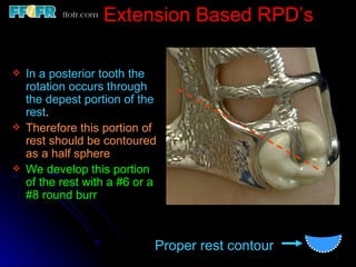 2.rpd biomechanics | PPT